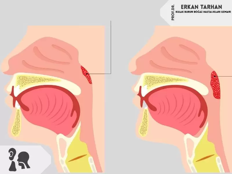Geniz Eti (Adenoid Vejetasyon)