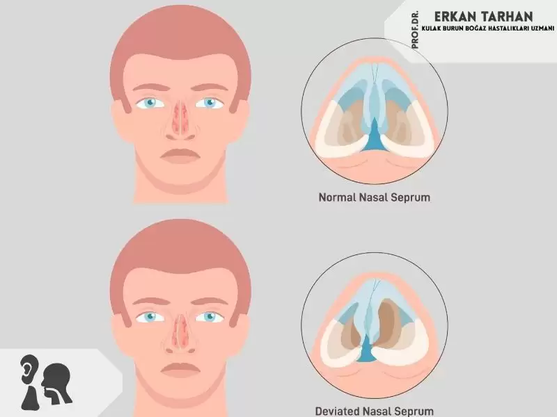 Septum Deviasyonu (Burun İç Eğriliği)