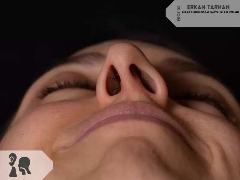 septum-deviasyonu-nedir